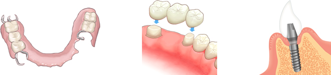歯を失った時の治療法の種類